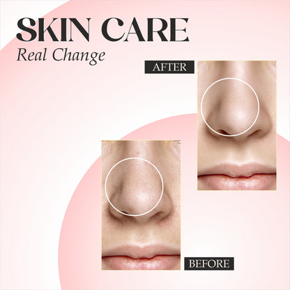 AV Bloom Niacinamide Serum for Reducing Blemishes & Acne Marks, 30ml (1.01 fl oz)